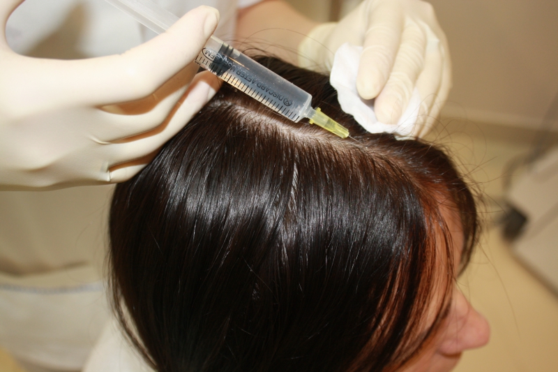 Мезотерапия волос в Казани